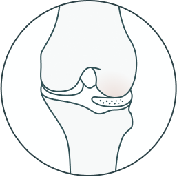 meniscus design