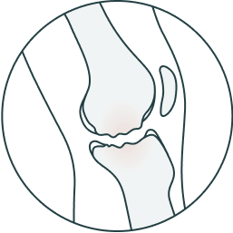 Osteochondral defects design