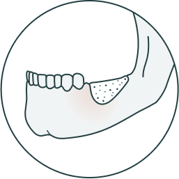 Bone reconstruction for dental implants design